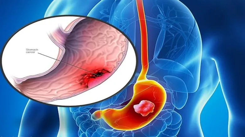 Xét nghiệm CA 72-4 và ý nghĩa trong chẩn đoán ung thư