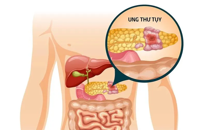 Xét nghiệm CA199 là gì? Ý nghĩa và những điều cần biết