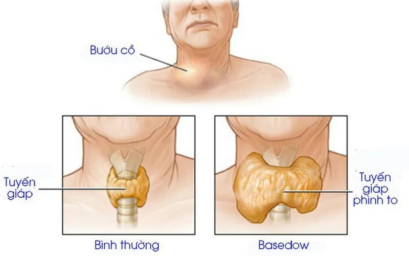 Xét nghiệm TRAb: Xét nghiệm chẩn đoán bệnh Basedow