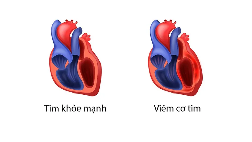 Xét nghiệm troponin T là gì? Ý nghĩa của xét nghiệm troponin T