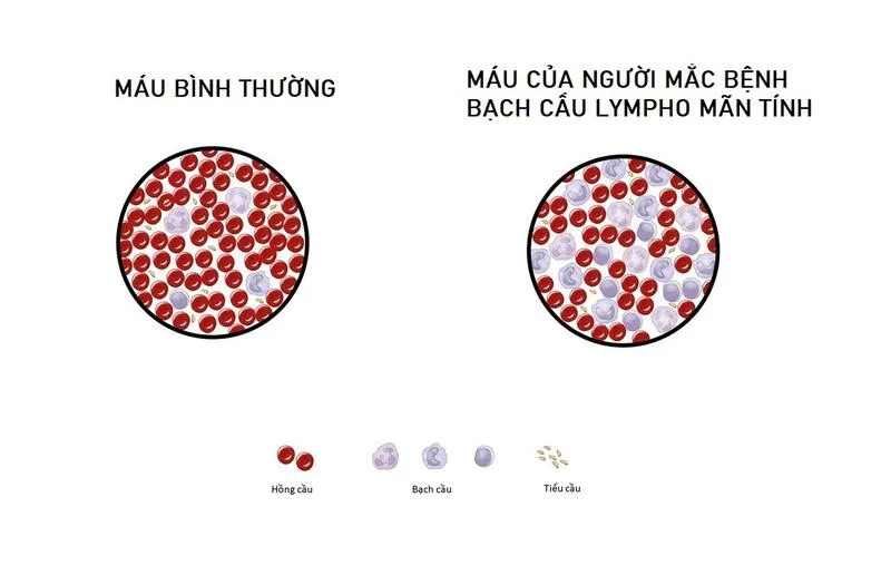 Bệnh bạch cầu lymphocytic mãn tính: Nguyên nhân, triệu chứng, cách điều trị