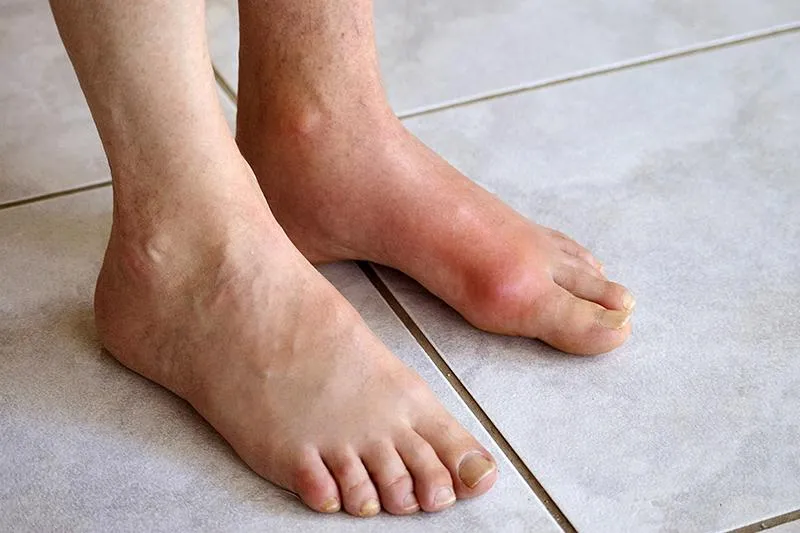 Bệnh gout có ăn hàu được không?