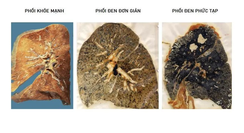 Bệnh phổi đen: Nguyên nhân, triệu chứng và cách điều trị