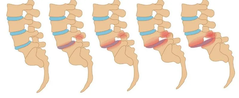 Bị trật khớp lưng phải làm sao? Cách nhận biết trật khớp lưng