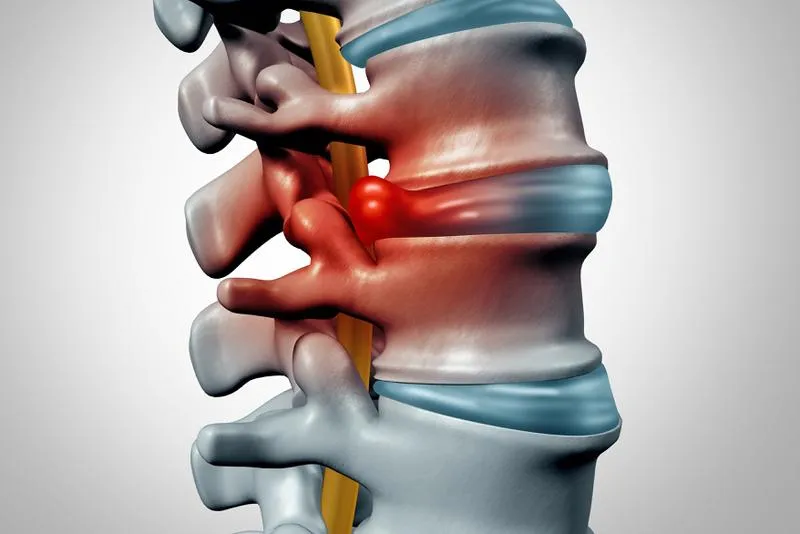 Bị trật khớp lưng phải làm sao? Cách nhận biết trật khớp lưng