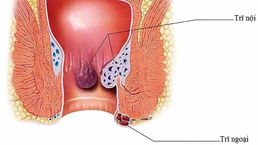 Bị trĩ uống thuốc có hết không? Phân loại và cấp độ bệnh trĩ