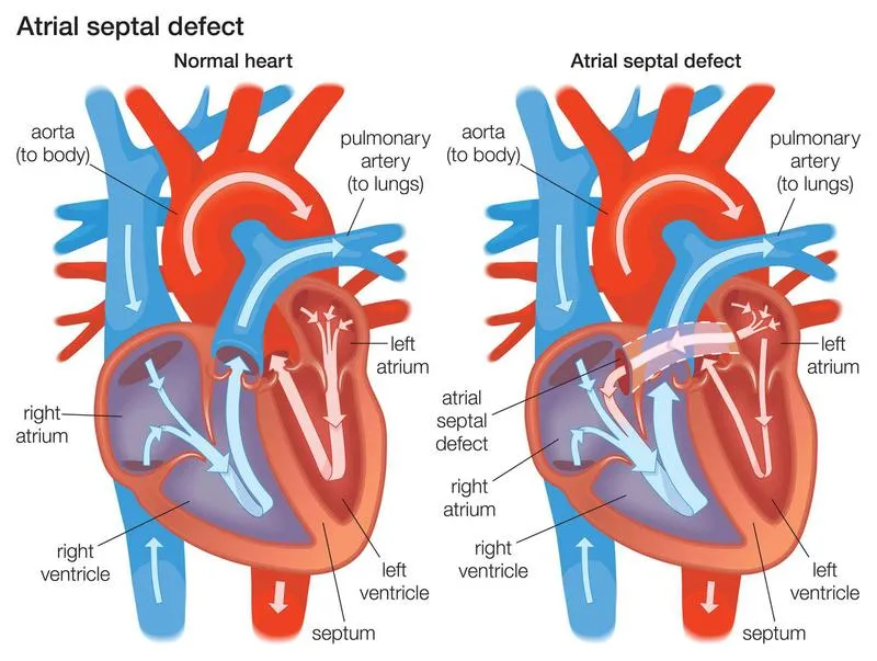 Biến chứng sau mổ thông liên nhĩ mà bạn có thể gặp phải