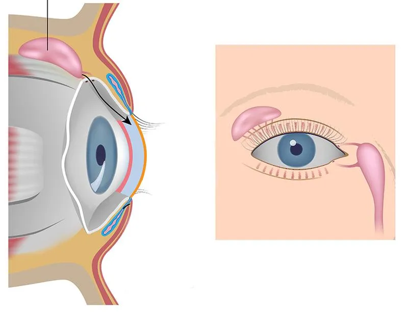 Cấu tạo tuyến lệ và những bệnh thường gặp