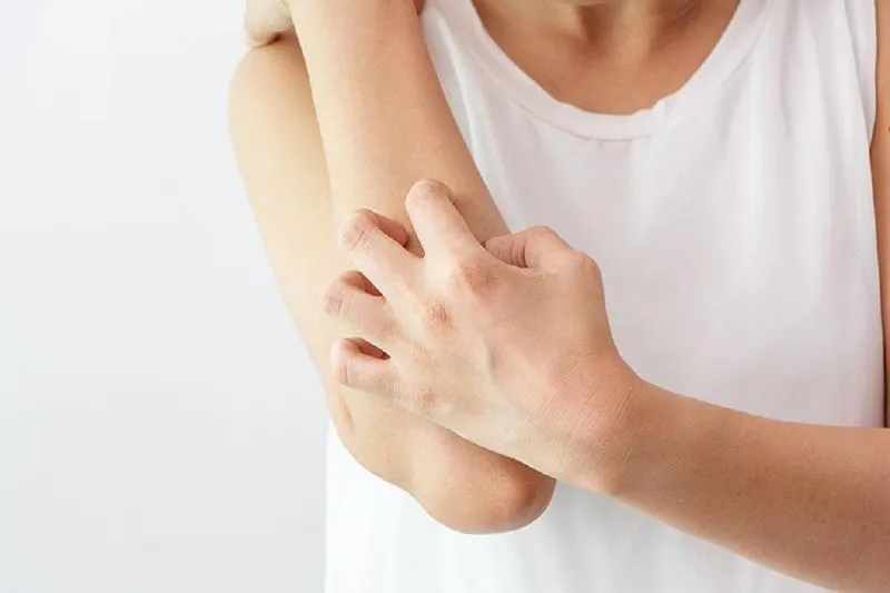 Da bị nổi sần như da gà và ngứa: Dấu hiệu cảnh báo căn bệnh Keratosis Pilaris