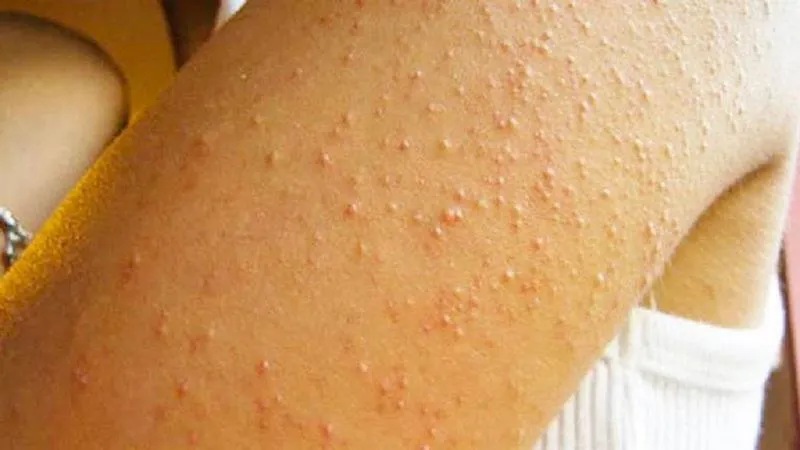 Da bị nổi sần như da gà và ngứa: Dấu hiệu cảnh báo căn bệnh Keratosis Pilaris