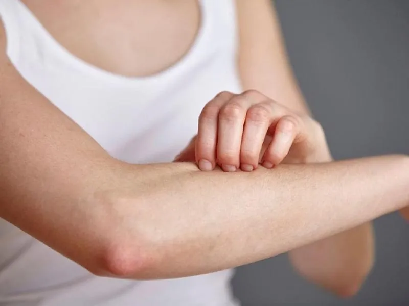 Da bị nổi sần như da gà và ngứa: Dấu hiệu cảnh báo căn bệnh Keratosis Pilaris