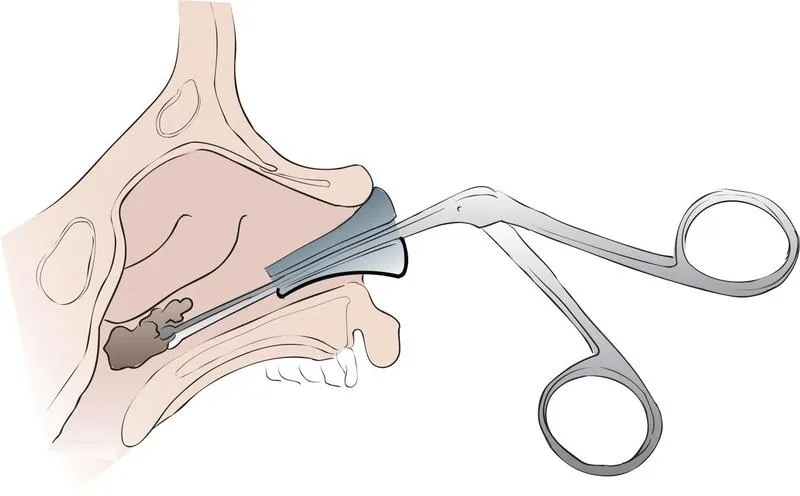 Dị vật trong mũi có rơi xuống phổi không? Phương pháp xử lí và những lưu ý cần biết