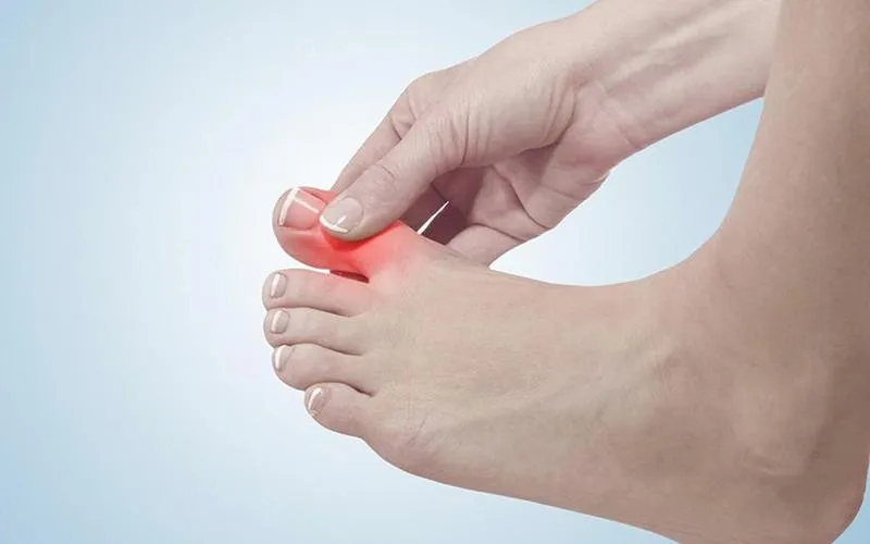 Điểm danh những loại thuốc trị gout của Pháp tốt nhất hiện nay