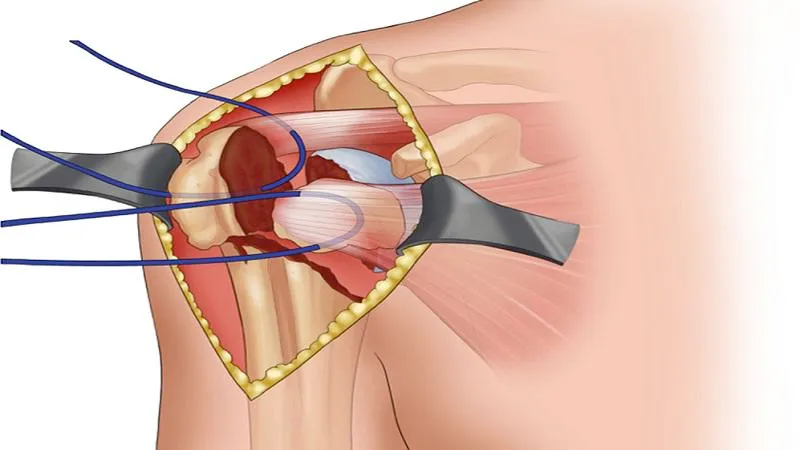 Gãy đầu trên xương cánh tay: Nguyên nhân, dấu hiệu và giải pháp