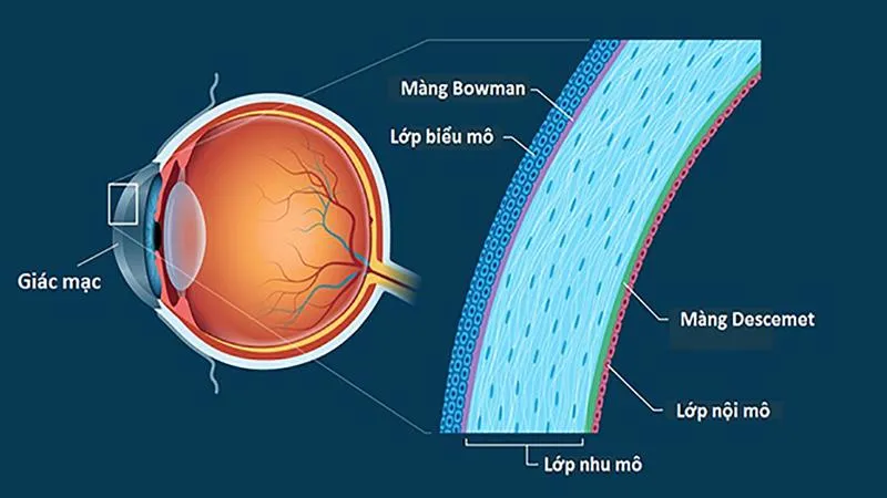 Giác mạc mỏng có mổ cận được không?