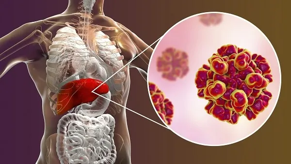 HBV-DNA là gì? Ý nghĩa của xét nghiệm HBV-DNA