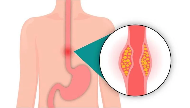 Hẹp thực quản: Nguyên nhân và cách điều trị