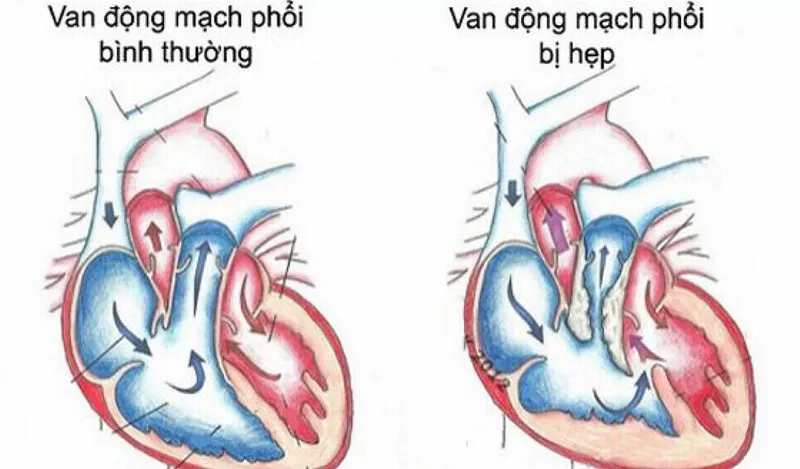 Hẹp van động mạch phổi có mấy mức độ?