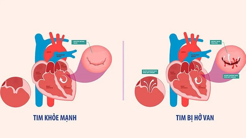 Hở van tim có di truyền không? Biết để phòng ngừa hiệu quả