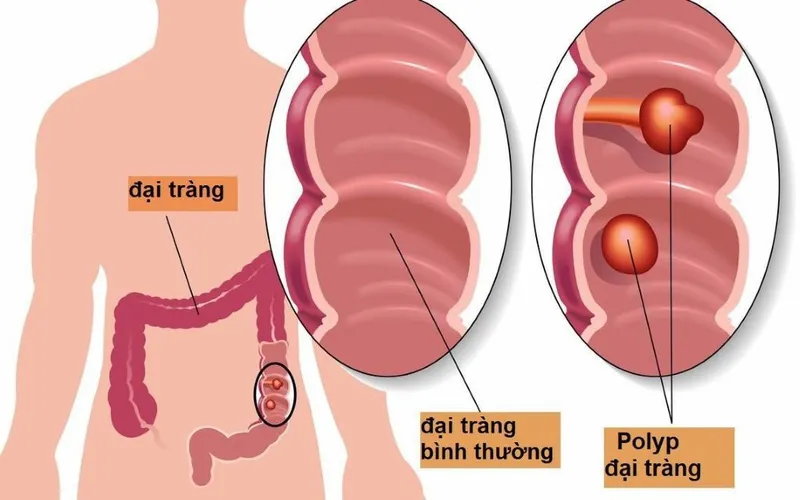 Hội chứng đa polyp MUTYH: Nguyên nhân, cơ chế di truyền và phương pháp tầm soát bệnh