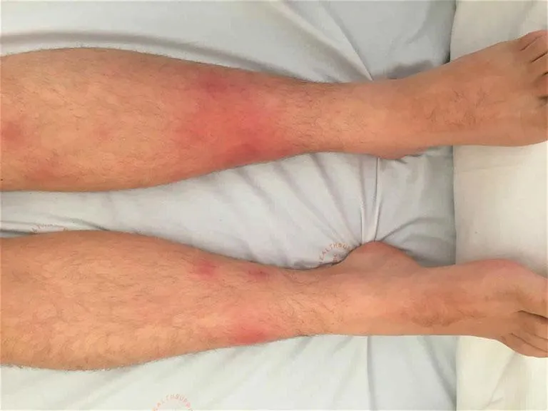 Hội chứng hồng ban nút (erythema nodosum)