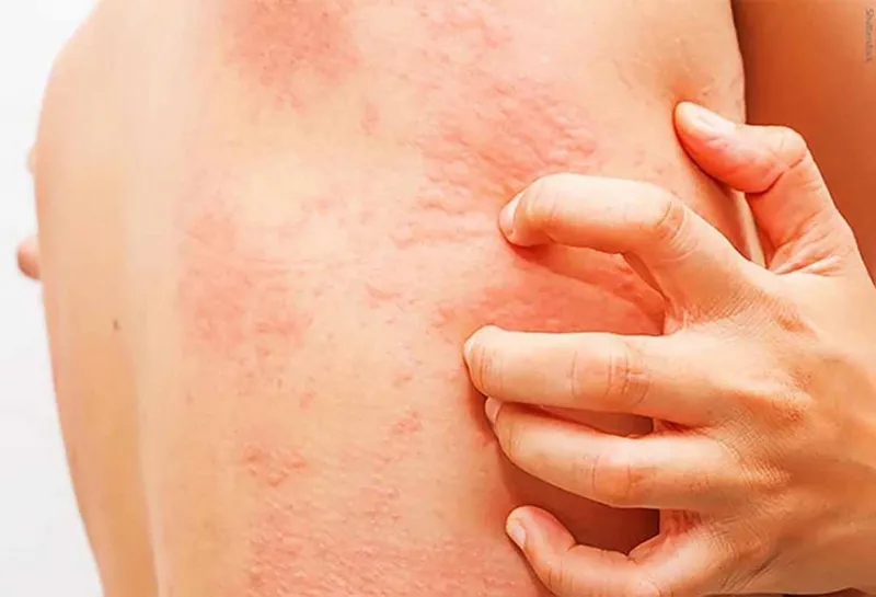 Hội chứng hồng ban nút (erythema nodosum)