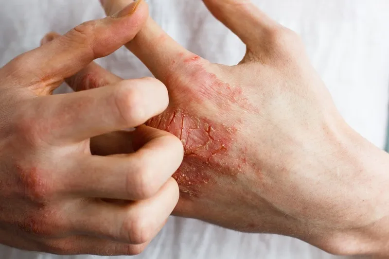 Hội chứng hồng ban nút (erythema nodosum)