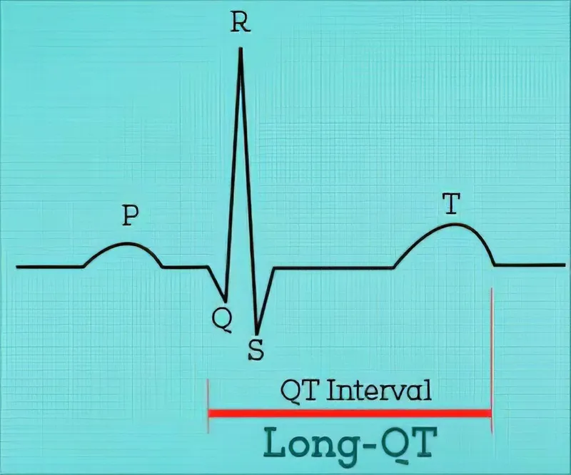 Hội chứng khoảng QT dài là gì? Nguyên nhân nào gây ra hội chứng khoảng QT dài?