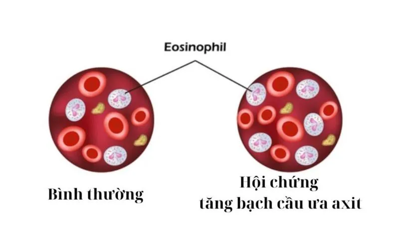 Hội chứng tăng bạch cầu ưa axit: Nguyên nhân, triệu chứng và cách chữa trị