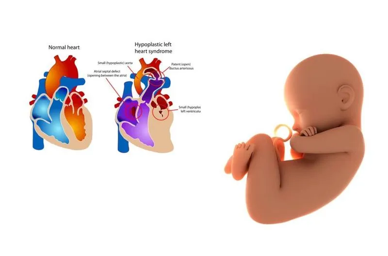 Hội chứng thiểu sản tim trái là gì? Nguyên nhân, triệu chứng, cách điều trị