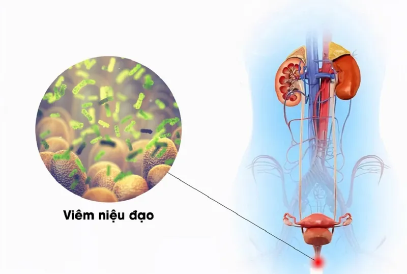 Lý giải vì sao viêm niệu đạo dễ tái phát