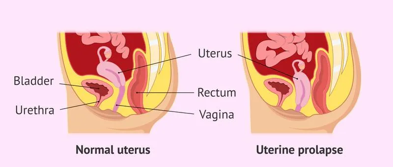 Mách bạn cách bấm huyệt chữa sa tử cung cực hiệu quả