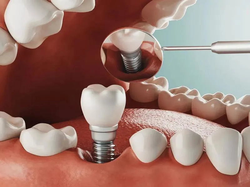 Mất răng có bị lệch mặt không? Bạn cần làm gì khi bị mất răng?