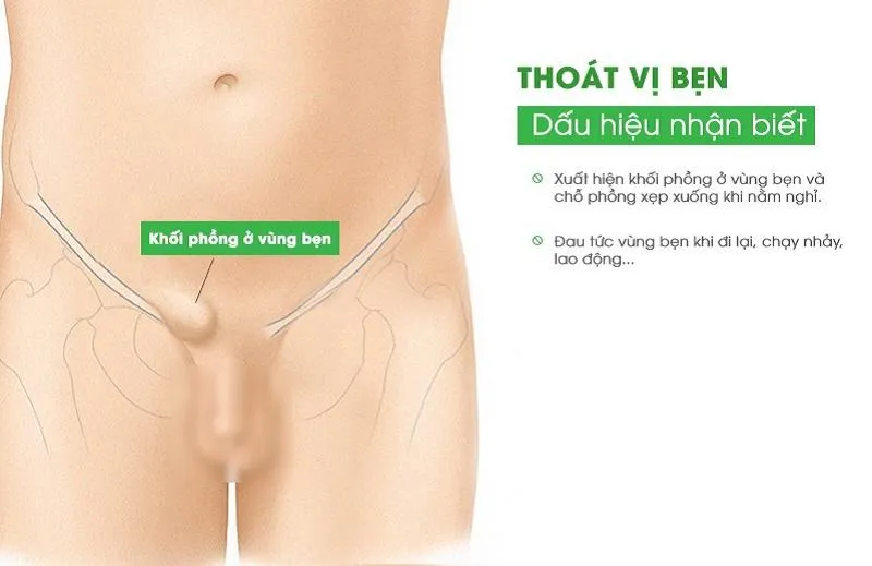 Mổ thoát vị bẹn bao lâu thì lành? Cùng những giải đáp xung quanh