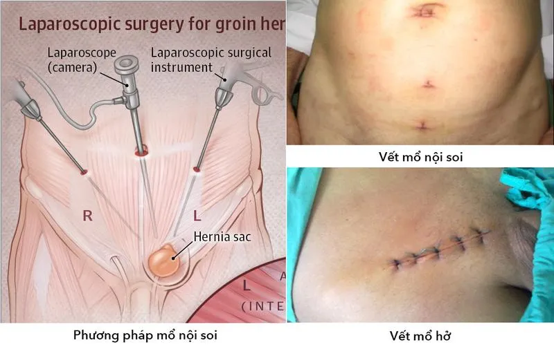 Mổ thoát vị bẹn có nguy hiểm không? Các phương pháp điều trị cho bệnh nhân