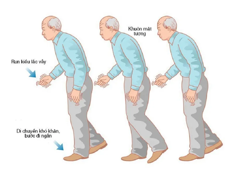 Những biến chứng của bệnh Parkinson ảnh hưởng nghiêm trọng đến sức khỏe người bệnh