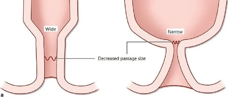 Những điều bạn cần biết về hẹp hậu môn ở trẻ em