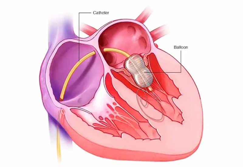 Những điều bạn cần biết về hẹp hậu môn ở trẻ em