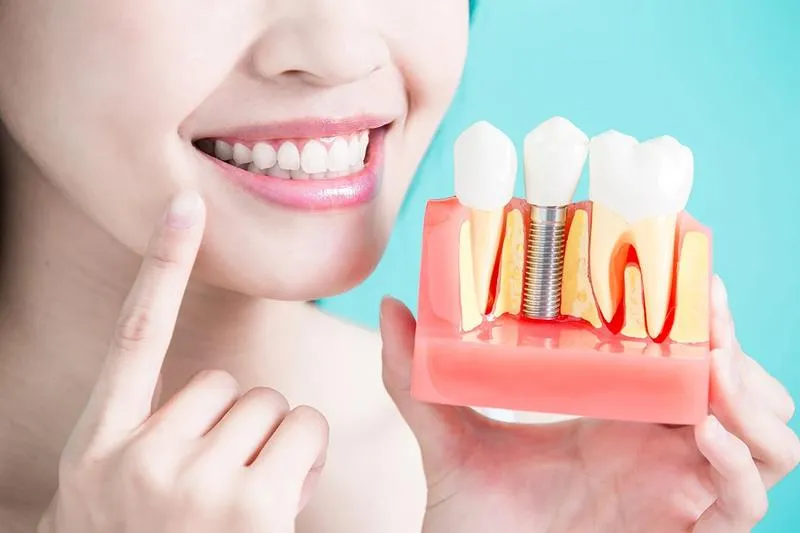 Nhược điểm của trồng răng implant có thể bạn chưa biết