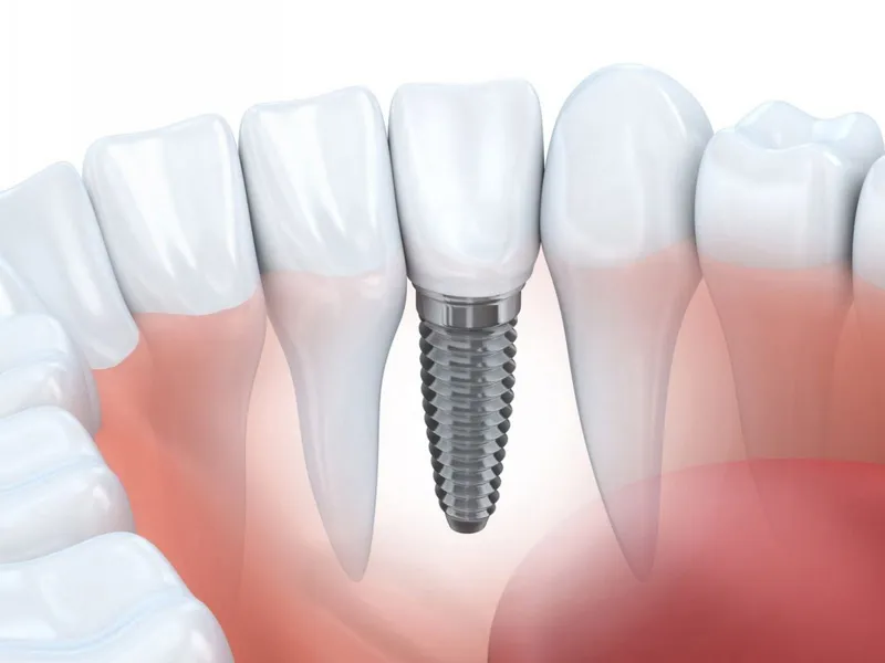 Nhược điểm của trồng răng implant có thể bạn chưa biết