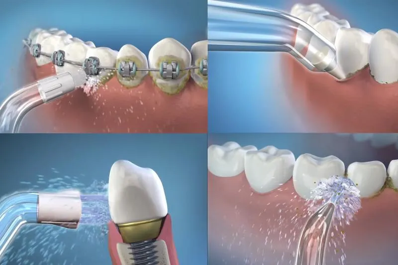 Nhược điểm của trồng răng implant có thể bạn chưa biết