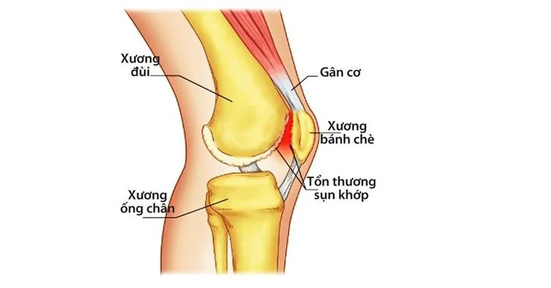 Nhuyễn sụn bánh chè: Nguyên nhân, triệu chứng, cách điều trị và biện pháp phòng ngừa