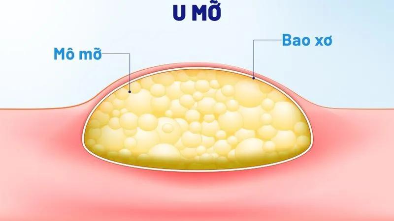 Nổi hạch ở mông là bị bệnh gì? Nên xử lý như thế nào?