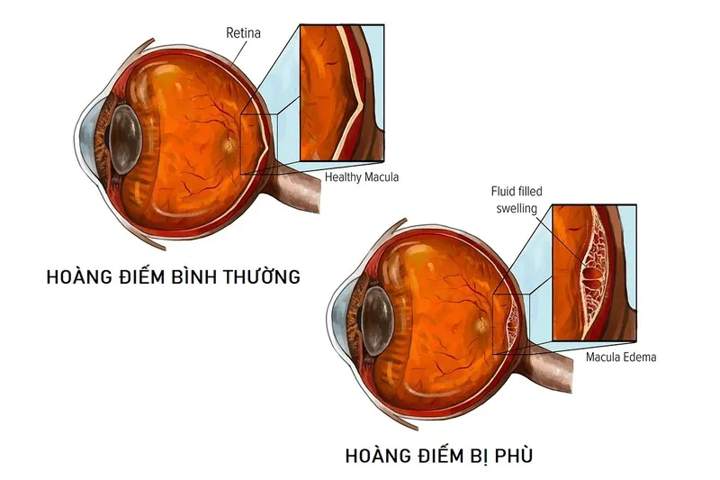 Phù hoàng điểm do tiểu đường: Nguyên nhân, triệu chứng, cách điều trị