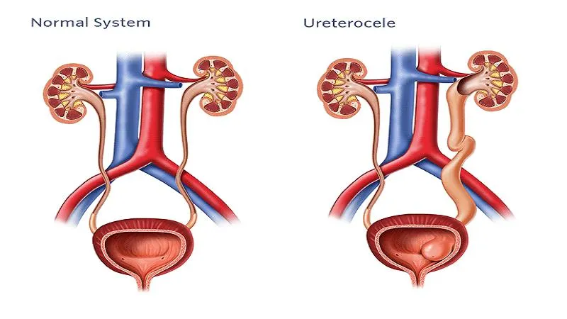 Sa lồi niệu quản: Dấu hiệu, nguyên nhân, chẩn đoán và can thiệp