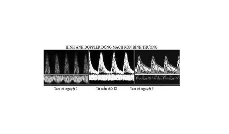 Siêu âm Doppler động mạch rốn và những lợi ích trong thai kỳ