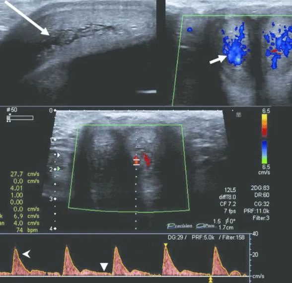 Siêu âm Doppler dương vật là gì? Có thể phát hiện những bệnh lý gì?