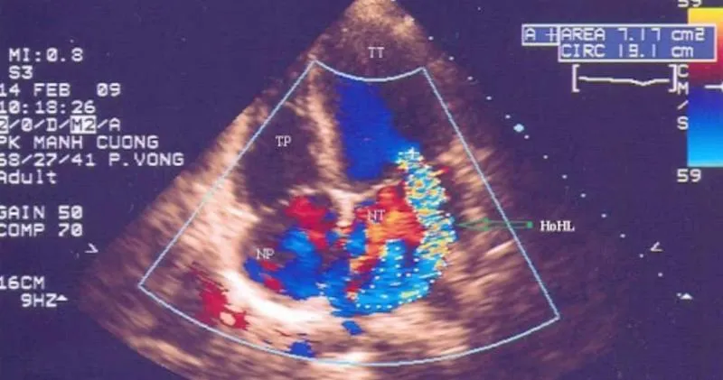 Siêu âm Doppler tim là gì? Kết quả siêu âm cho thấy điều gì?