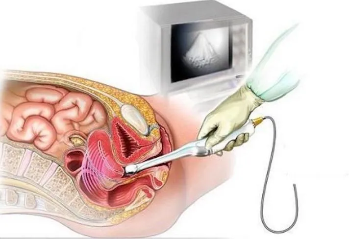 Siêu âm tử cung phần phụ là gì? Đối tượng nào cần siêu âm?