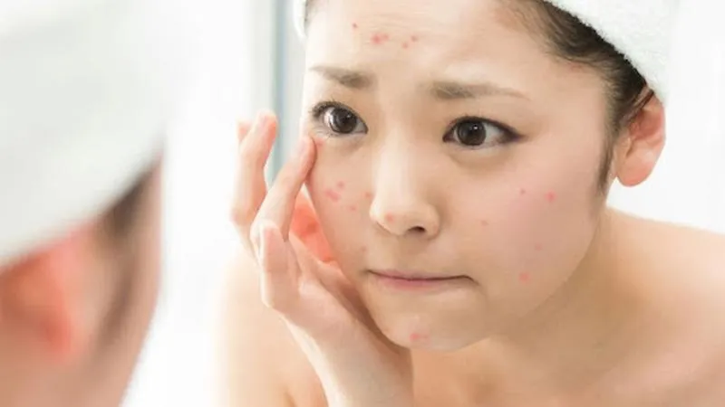 Sử dụng kem trị mụn Derma Forte có đẩy mụn không?